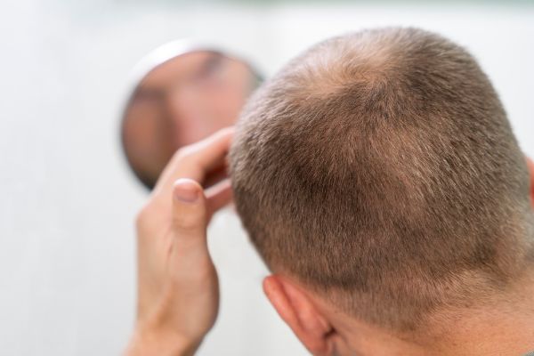 alopecia - injerto capilar